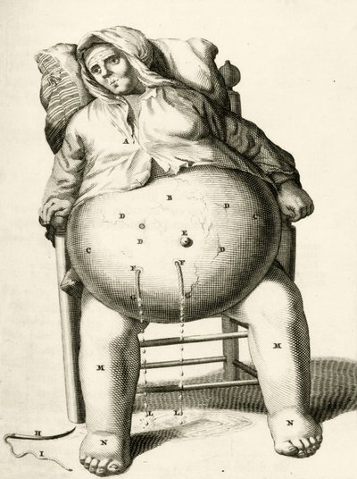 Drenando líquidos de un absceso, de Exercitationes Practicae circa Medendi Methodum por Frederik Dekkers, 1694 de Dutch School