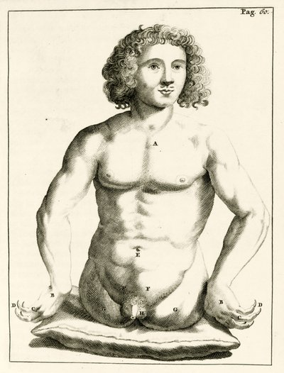 Ejemplo de defectos congénitos, de Exercitationes Practicae circa Medendi Methodum por Frederik Dekkers, 1694 de Dutch School