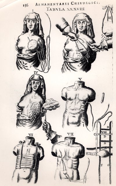 Operación de cáncer de mama, de Armamentarii Chirurgici por Johannes Schultes (1595-1645) publicado en Ámsterdam, 1672 de Dutch School
