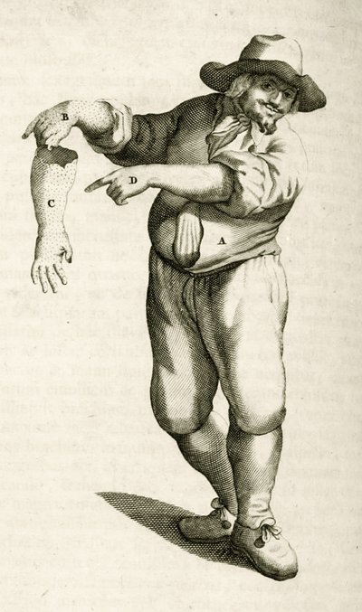 Eliminando piel muerta con pústulas, de Exercitationes Practicae circa Medendi Methodum por Frederik Dekkers, 1694 de Dutch School