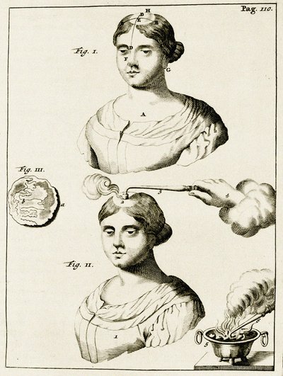 Tratando a un paciente con epilepsia, de Exercitationes Practicae circa Medendi Methodum por Frederik Dekkers, 1694 de Dutch School