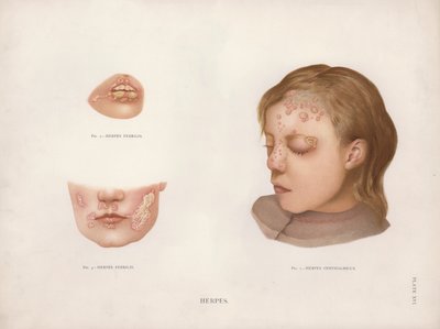 Enfermedades de la Piel: Herpes de English School
