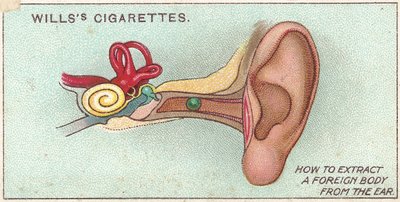 Cuerpo extraño en el oído, no. 30 de la serie de primeros auxilios de las tarjetas de cigarrillos de Willss, 1913 de English School