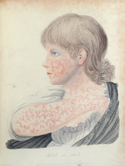 Rubéola, ilustración para un libro de Robert Willan (1757-1812), 1808 de English School