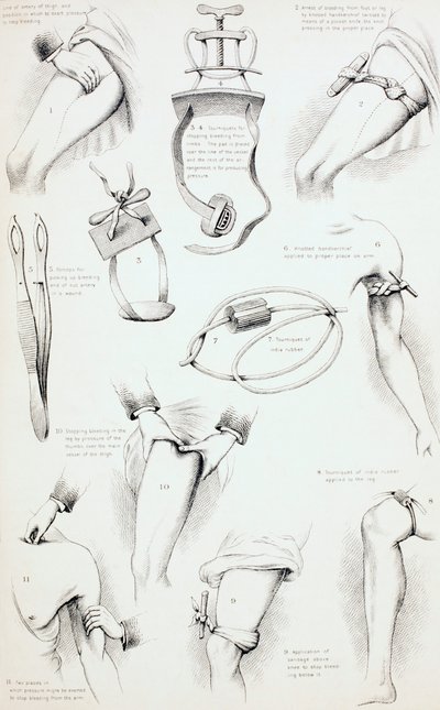 Métodos para Detener el Sangrado, c.1890 de English School