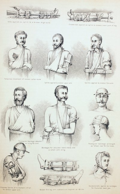 Tratamiento Temporal de Fracturas, c.1890 de English School