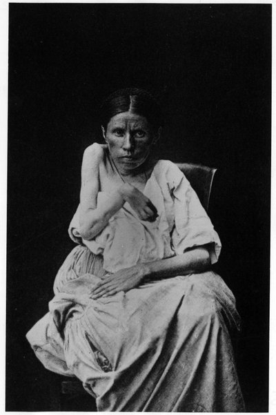 Fotografía de un paciente que sufre de epilepsia hemipléjica, en “iconografía fotográfica de la Salpetrière, Bourneville y P. Regnard, París de French Photographer