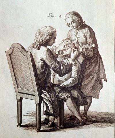 Un médico operando a un paciente de cataratas, ilustración de la Enciclopedia Médica de Denis Diderot y Jean le Rond d