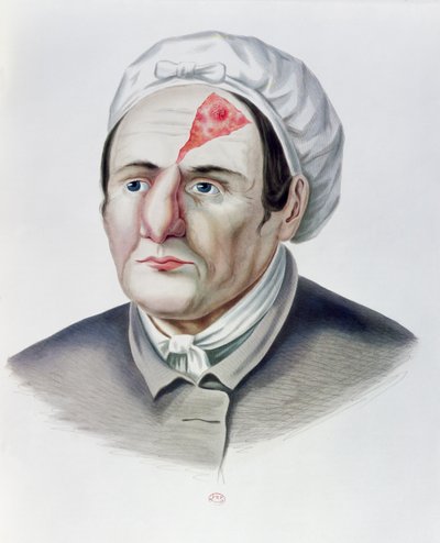 Después de una operación de injerto de piel, de Selecta Praxis Medico-Chirurgica por Alexander Auvert, París, 1856 de French School