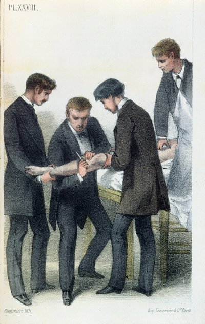 Amputación de un brazo, de un manual médico por Jean-Baptiste-Leon Dubreuil, c.1850-60 de French School