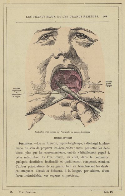 Aplicación de un tópico en la amígdala, mediante el pincel de French School