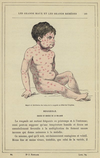 Aspecto y distribución de las manchas del sarampión al inicio de la erupción de French School