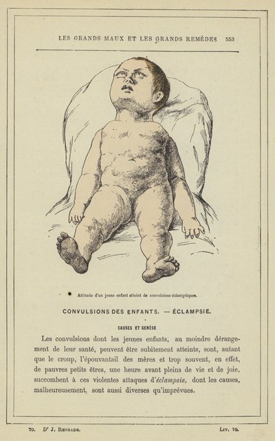 Actitud de un niño pequeño con convulsiones eclámpticas de French School