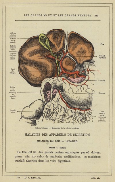Cálculos biliares, Mecanismo del cólico hepático de French School