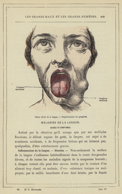 Cáncer ulcerado de la lengua, Degeneración de los ganglios de French School