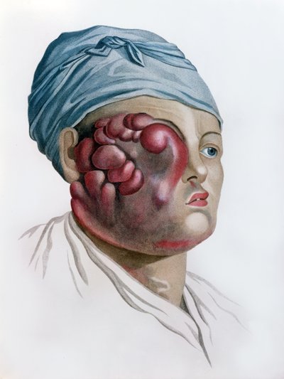Escrofula cancerosa, de Description des Maladies de la Peau por Baron Jean Louis Alibert (1768-1837) París, 1806 de French School