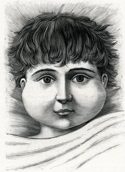 Niño con paperas (grabado) 1888 de French School