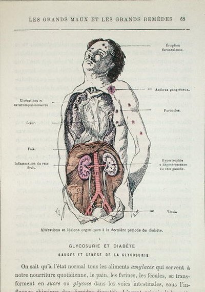 Efectos de la diabetes, de 