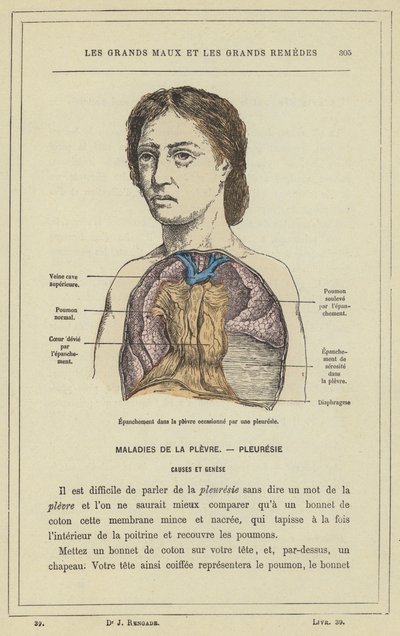 Derrame en la pleura ocasionado por una pleuresía de French School