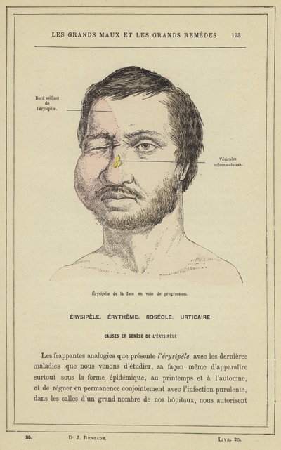 Erisipela de la cara en progreso de French School