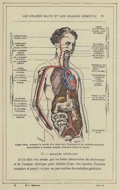 Figura ideal, mostrando el curso de un virus en el cuerpo y los accidentes sucesivos de una diátesis de evolución completa, según la teoría del autor de French School
