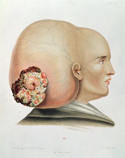 Hongo de la duramadre, de Selecta Praxis Medico-Chirurgica por Alexander Auvert, París, 1856 de French School