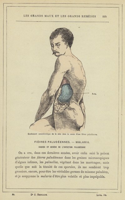 Hinchazón característica del bazo durante una fiebre palúdica de French School