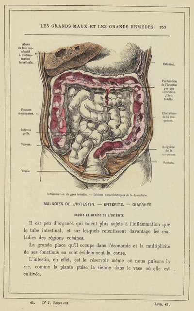 Inflamación del intestino grueso, Lesiones características de la disentería de French School
