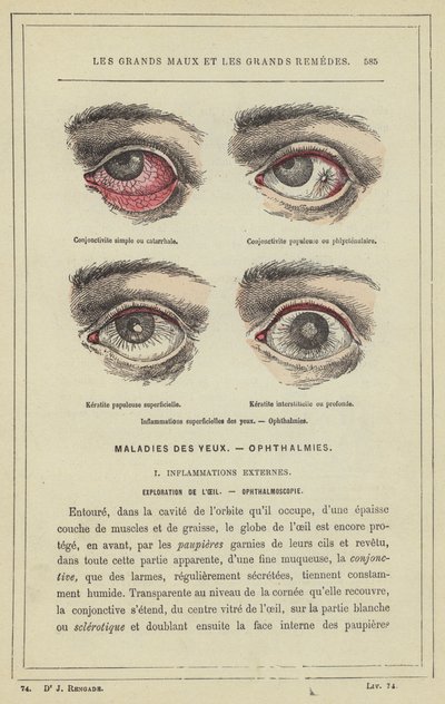Inflamaciones superficiales de los ojos, Oftalmías de French School
