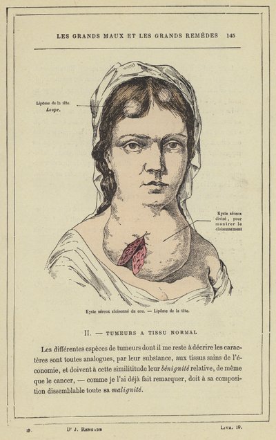Quiste seroso tabicado del cuello, Lipoma de la cabeza de French School