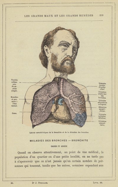 Lesiones características de la bronquitis y la dilatación de los bronquios de French School