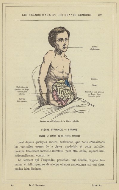 Lesiones características de la fiebre tifoidea de French School