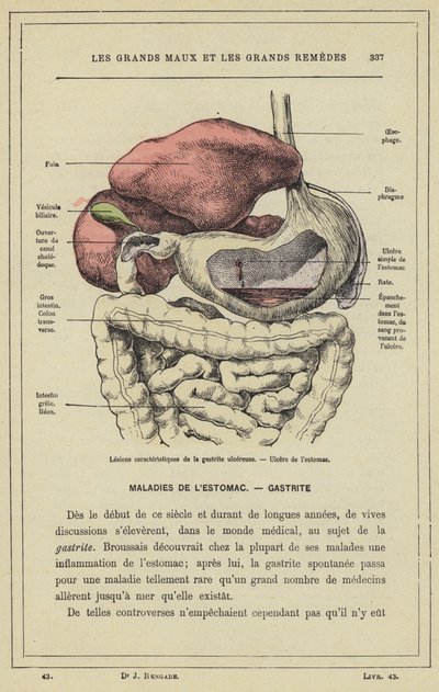 Lesiones características de la gastritis ulcerosa, Úlcera de estómago de French School
