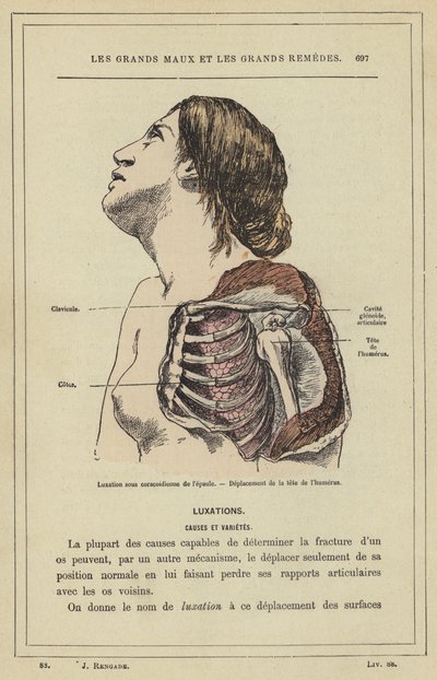 Luxación subcoracoidea del hombro, desplazamiento de la cabeza del húmero de French School
