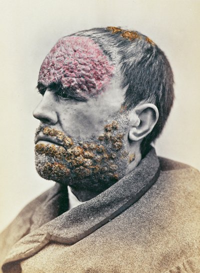 Hombre sufriendo de sífilis, de una fotografía tomada para la Clinique Photographique de l