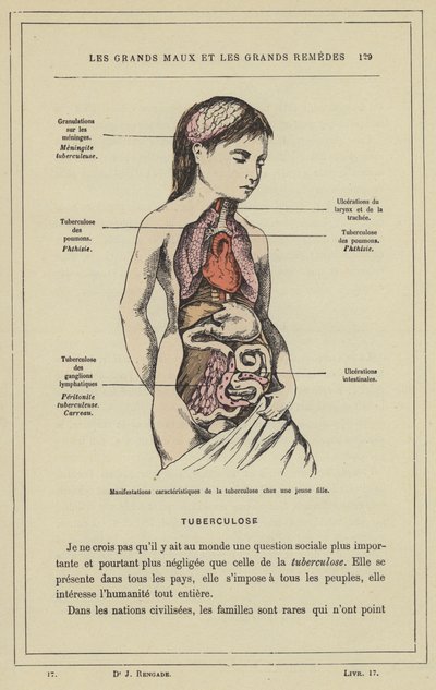 Manifestaciones características de la tuberculosis en una joven de French School