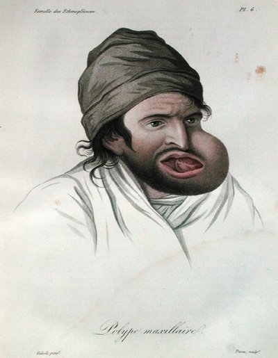 Pólipo maxilar, de un libro de Baron Jean Louis Alibert (1768-1837) 1817 de French School