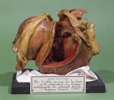 Modelo de un tumor del ventrículo izquierdo, 1799 de French School