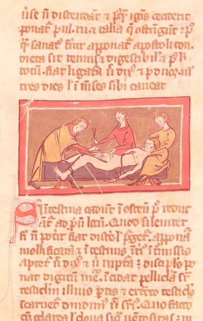 Ms H 89 fol.23 Cirugía, de una edición del Libro de Cirugía de Rogier de Salerne de French School