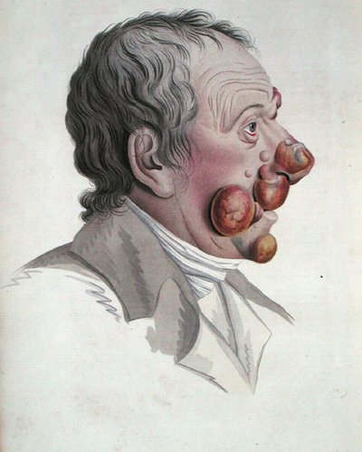 Micosis Fongoide, de un libro de Baron Jean Louis Alibert (1768-1837) 1838 de French School