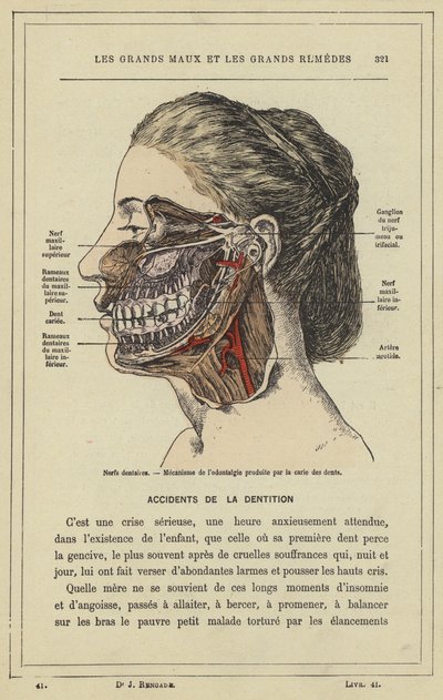Nervios dentales, Mecanismo del dolor dental producido por la caries de French School