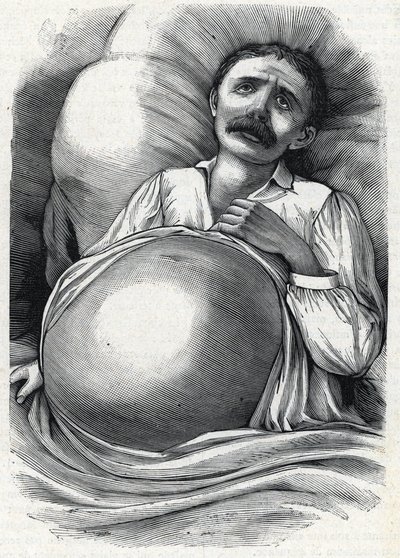 Paciente con cirrosis hepática avanzada (grabado) 1888 de French School