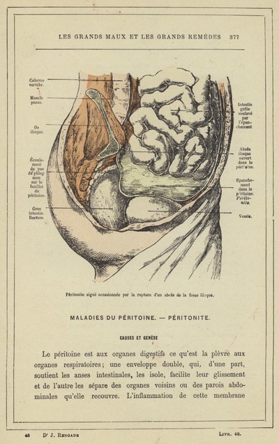 Peritonitis aguda ocasionada por la ruptura de un absceso de la fosa ilíaca de French School