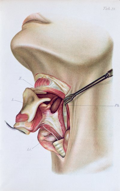 Placa de Atlas y Epítome de Cirugía Operativa por Dr. Otto Zuckerkandl, 1910 de French School
