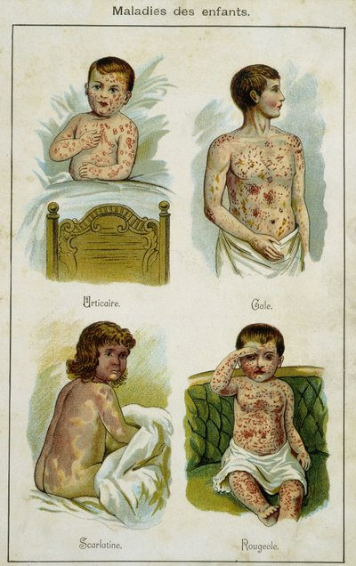 Placa que ilustra enfermedades infantiles: urticaria, sarna, escarlatina y sarampión (extraída de Bilz, medicación natural) finales del siglo XIX de French School
