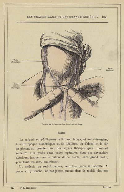 Posición de la lanceta en la sangría del brazo de French School