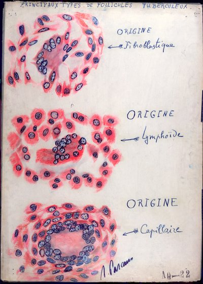 Folículos tuberculosos principales de French School
