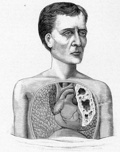 Representación de una persona con cavernas, complicación de tuberculosis (grabado) de French School