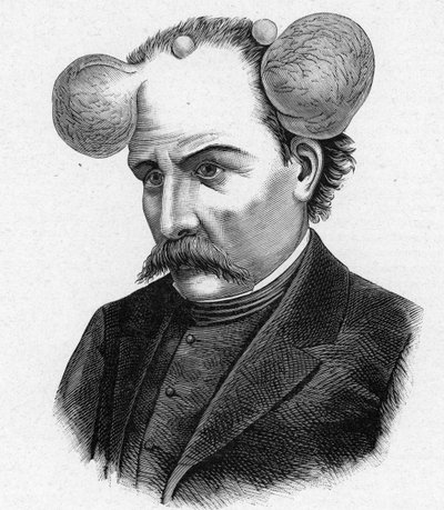 Representación de una persona con lupa, quistes en el cuero cabelludo (grabado) de French School