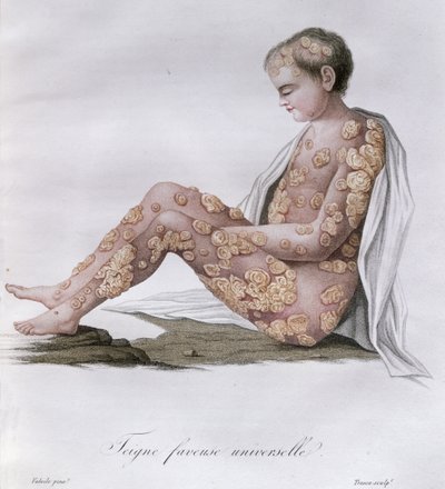 Tiña, de un libro de Baron Jean Louis Alibert, 1838 de French School